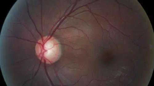 青光眼的克星来袭，助力患者远离视力的“窃贼”