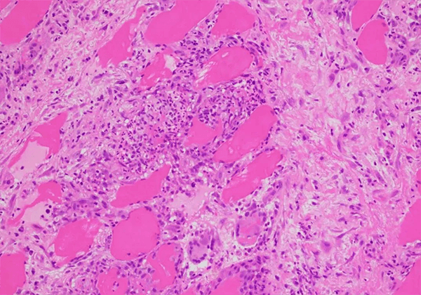 【尊龙凯时助力】治疗结节病的KBMAB-16获FDA批准临床